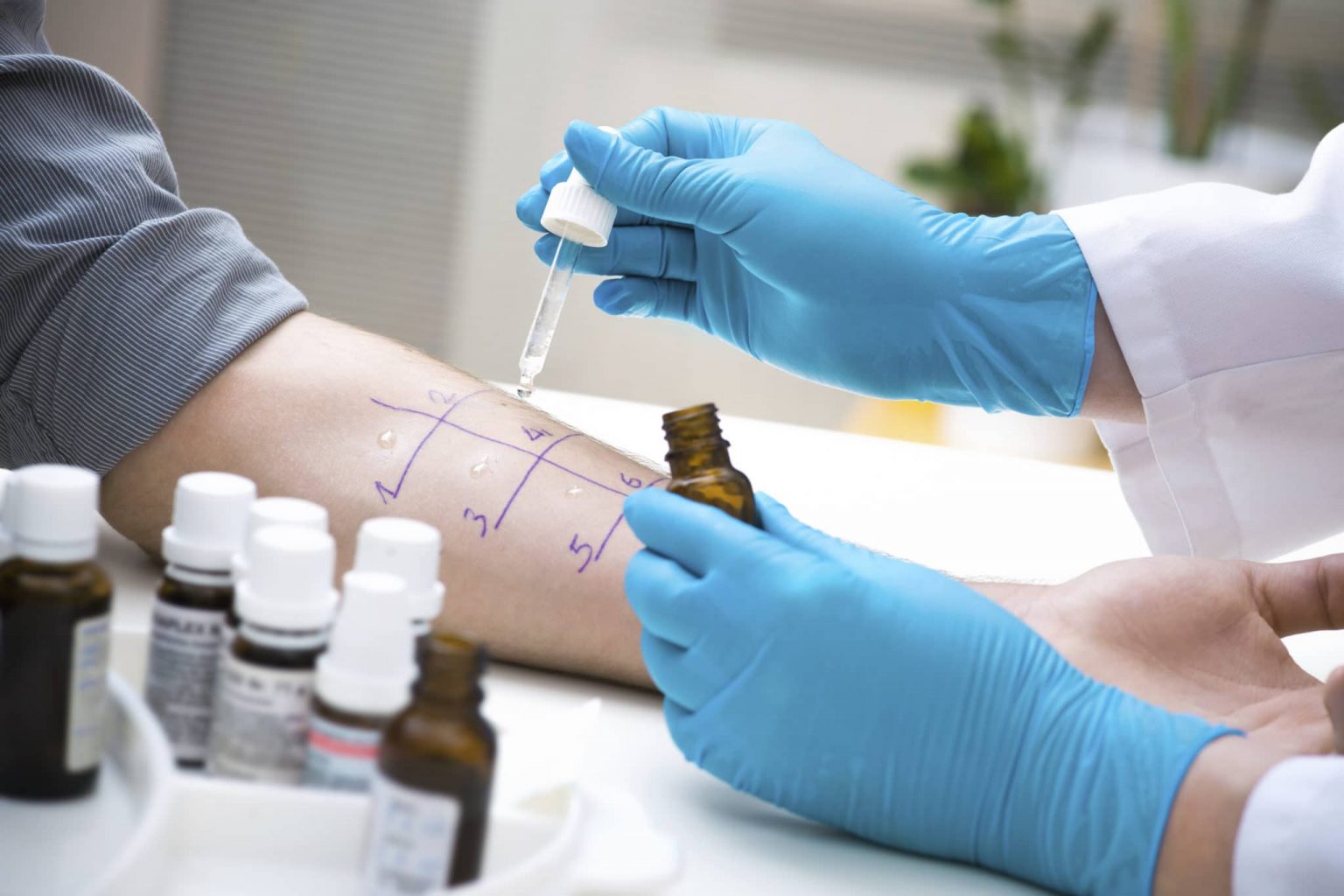 Doctor with gloves on using dropper to run an allergy test on patient's forearm